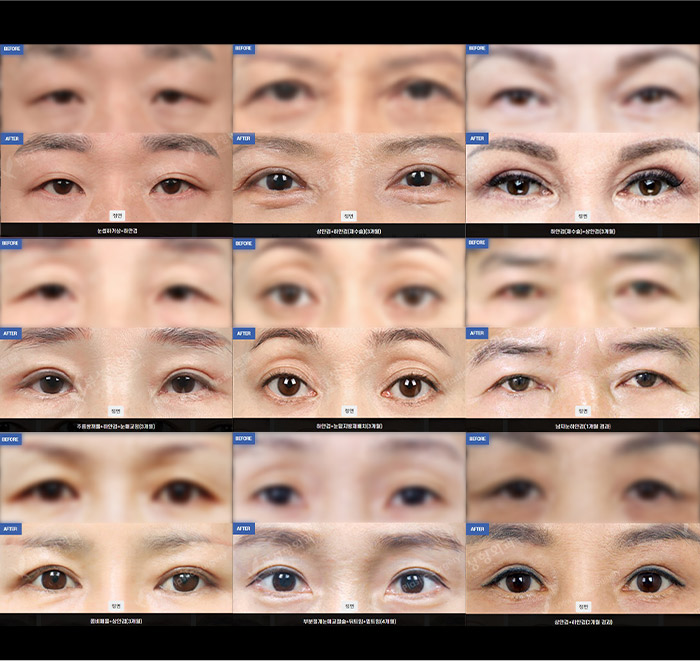 Sub Brow Lift 36 upper lower slide 04 mo