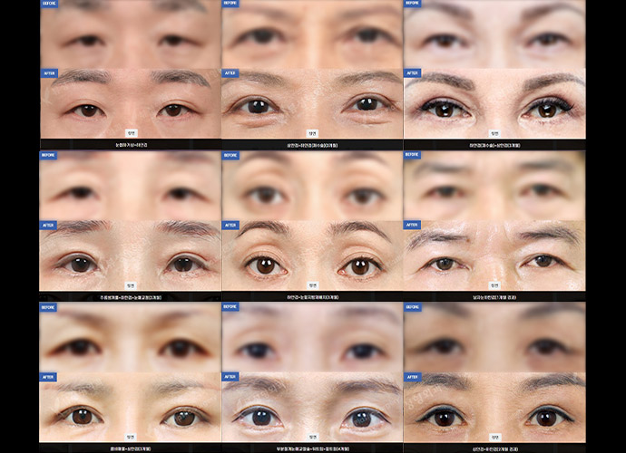 Sub Brow Lift 35 upper lower slide 04 pc