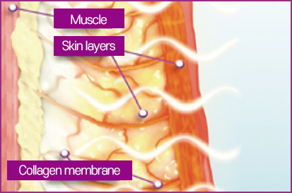 Delivering radiofrequency energy deep into the skin with Thermage FLX 사진