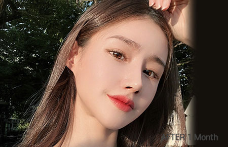 facial contour zygoma after