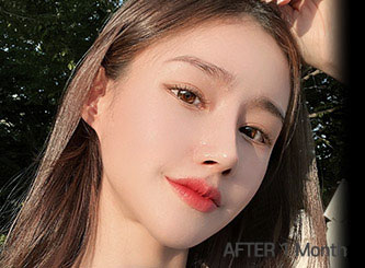 facial zygoma top after mo