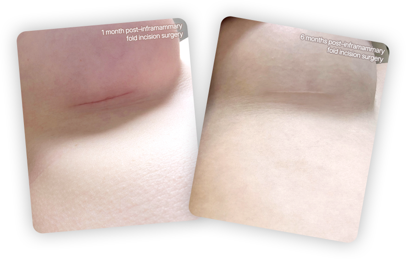 Post-operative scar healing system after breast augmentation