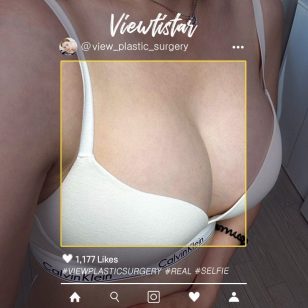 [Breast Augmentation (Sebbin)] Kang Doori | Plastic Surgery Korea