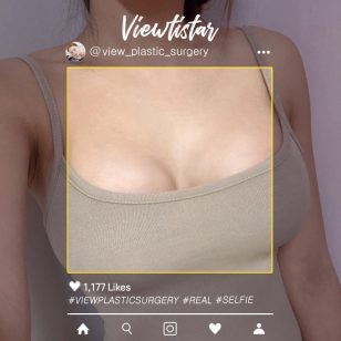 [Breast Augmentation (Sebbin)] Han Yeounsil | Plastic Surgery Korea